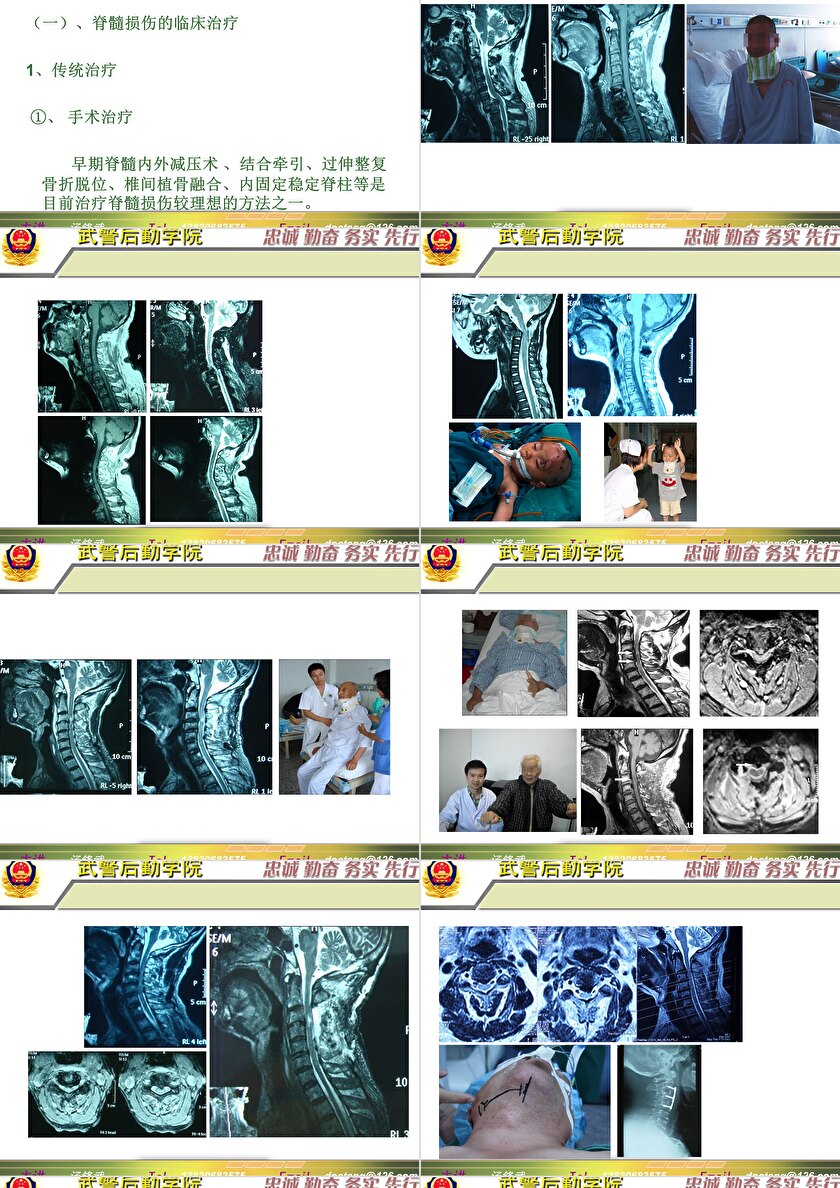 2023年脊髓損傷研究新進(jìn)展，里程碑式的突破與日常奇妙變化