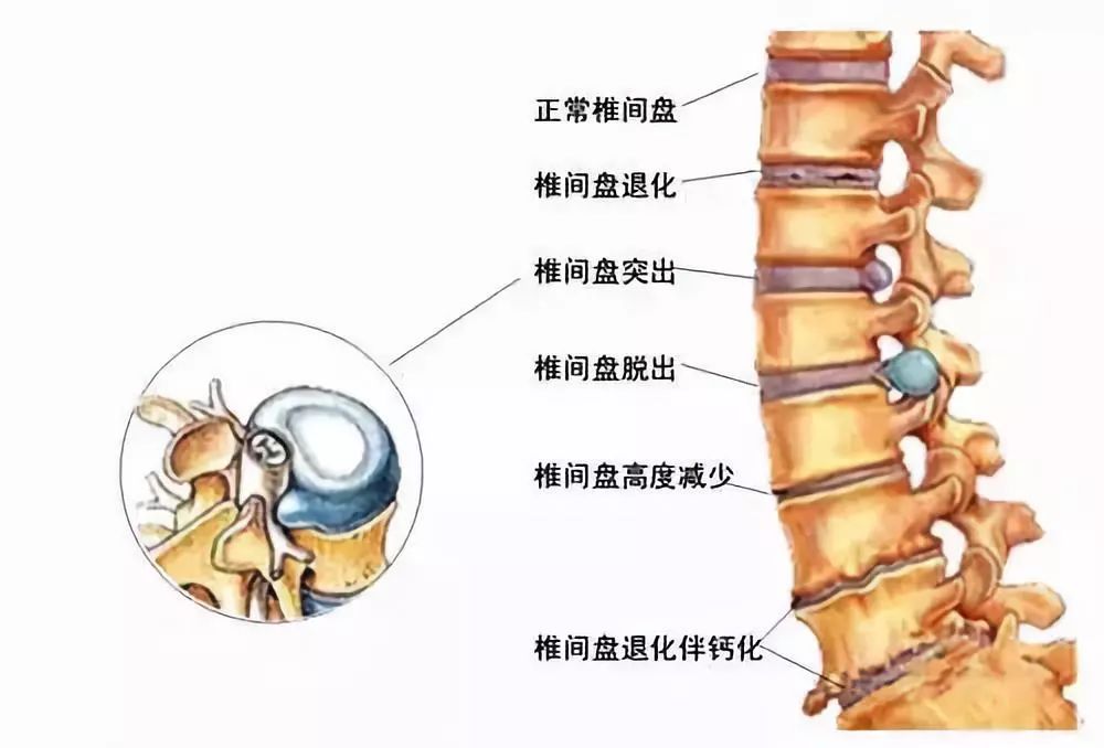 最新腰椎盤與歡樂大家庭的互動日常