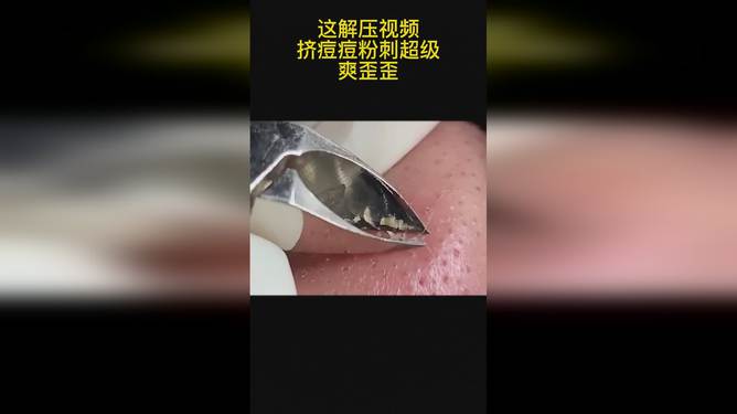 最新擠膿包視頻，見證變化的力量，自信與成就感的誕生之地